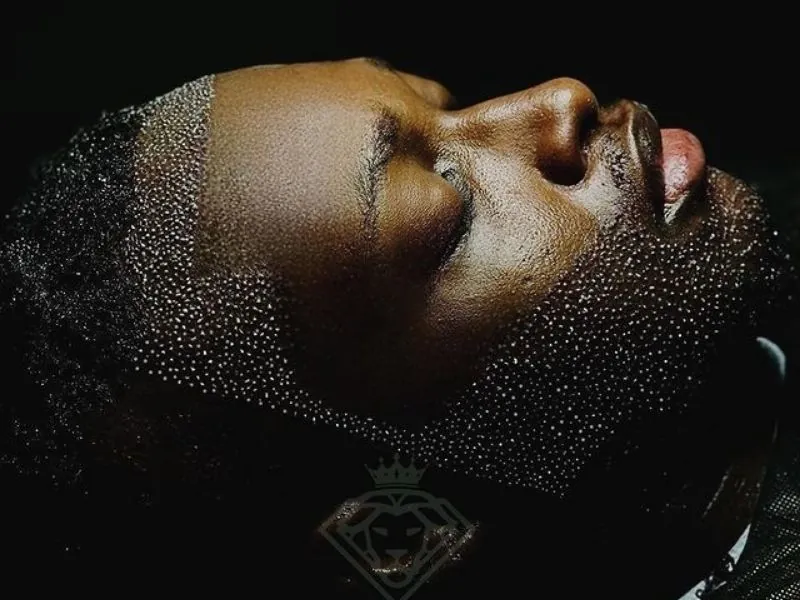 DHI Hair Transplant