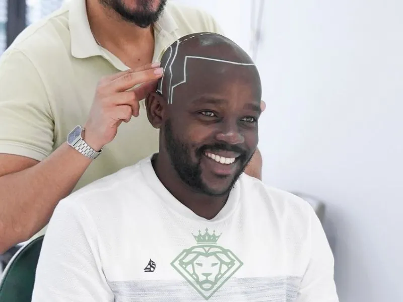 Hair Transplant (FUE)