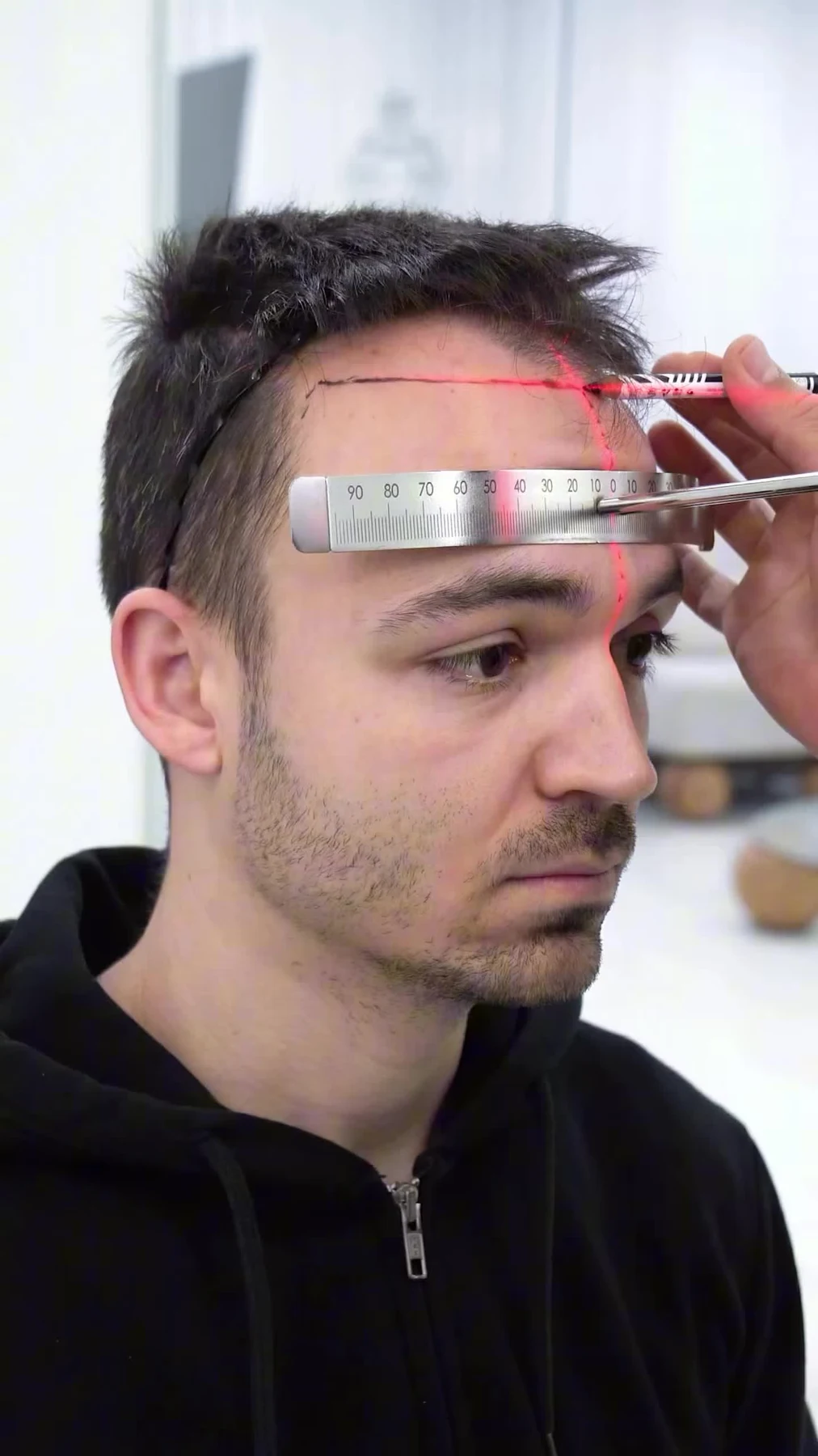 Hair Transplant (FUE)