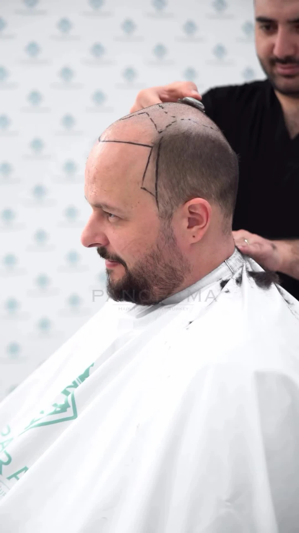 Hairline planning and patient preparation at Panorama Hair Turkey