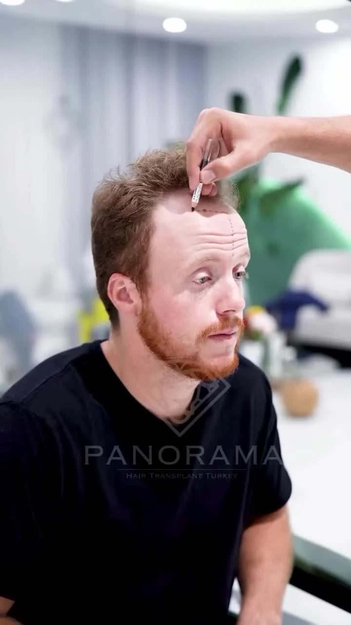 Hairline planning and patient preparation at Panorama Hair Turkey