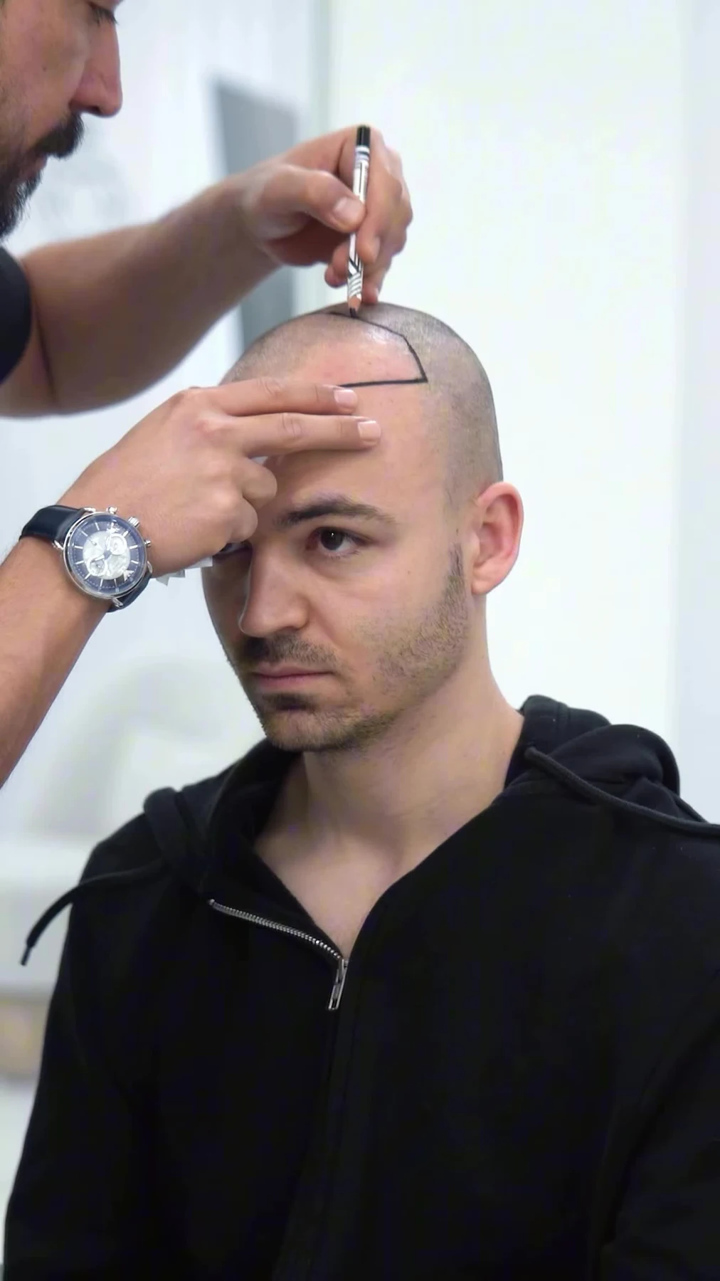 DHI Hair Transplant